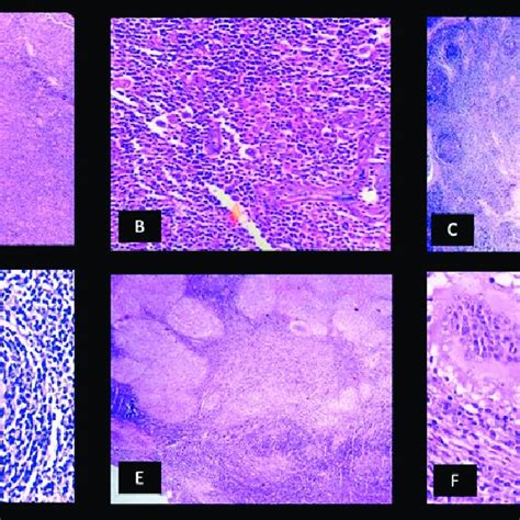 Histopathological Findings A Follicular Lymphoma 40× B Hodgkins