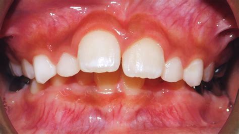 Class Ii Division 1 Malocclusion Class Ii Skeletal Convex Profile Retrognathic Mandible