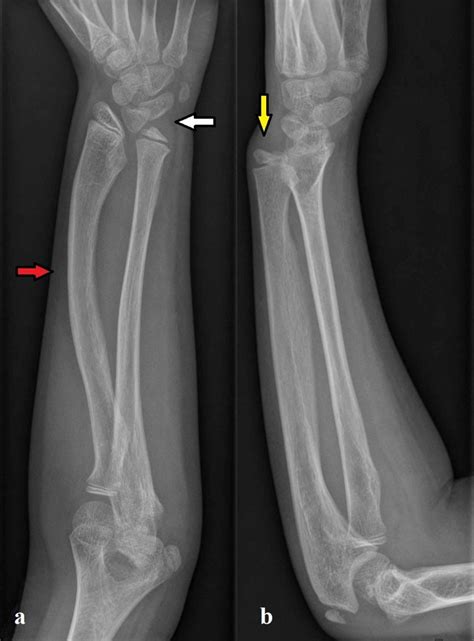 Radiography The Anteroposterior Radiograph A Of The Left Wrist Shows