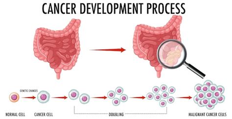 Free Vector Diagram Showing Cancer Development Process