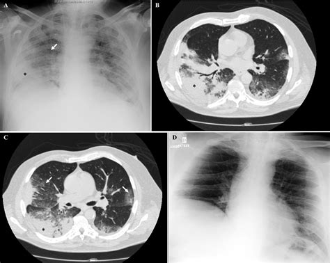 Daptomycin Induced Eosinophilic Pneumonia International Journal Of