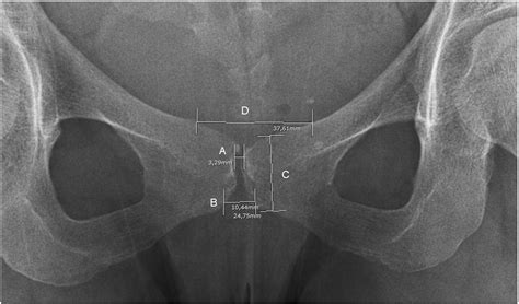 Assessment Of Postpartum Symphysis Pubis Distention With 3d Ultrasonography A Novel Method