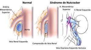 Varizes P Lvicas O Que S O Causas Sintomas E Tratamentos