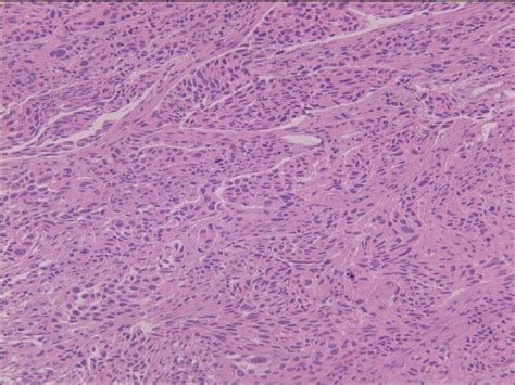 Solid Nests Of High Grade Urothelial Carcinoma Infiltrating The