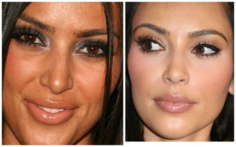 Kim Kardashian Before After Nose Job Kardashian Plastic Surgery