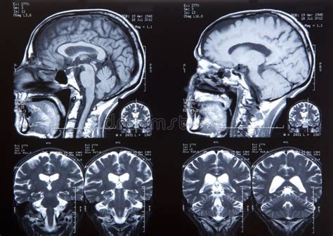 Tumor Cerebral Imagem De Stock Imagem De C Ncer Parietal