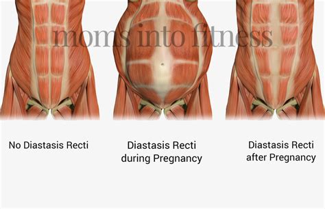 Diastasis Recti Exercise With An Ab Separation After Pregnancy