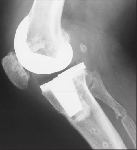 Postoperative Lateral Radiograph Of A Standard Total Knee Arthroplasty