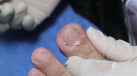 Ep3566 Ingrown Toenail Removal 👣 ออกมาเขียว เขียว 😷 Clip From