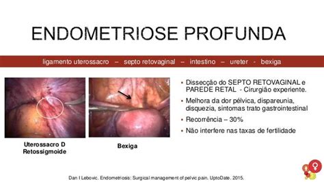 Videolaparoscopia Na Endometriose