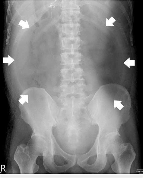 Figure 1 From The Football Sign An Alarming Feature On Supine