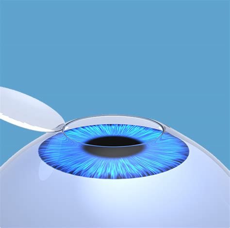 Bladeless Lasik Los Angeles Seibel Vision Barry Seibel Md