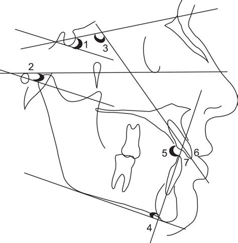 Cephalometric Measurements Used Gogn Sn Angle Formed By Lines S N