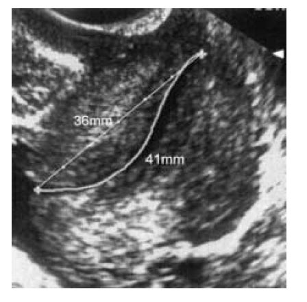 Transvaginal Ultrasound Evaluation Of The Cervix Measurement Of