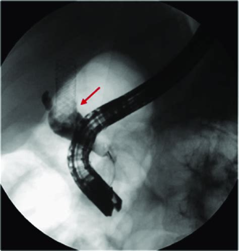 Cholangiogram From Ercp Showing Complete Occlusion Arrow Due To Download Scientific Diagram