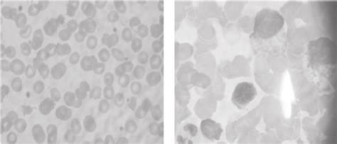 (a) Peripheral blood smear showing acanthocytes, and (b) bone marrow ...