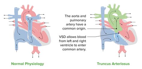 Truncus Arteriosus Concise Medical Knowledge