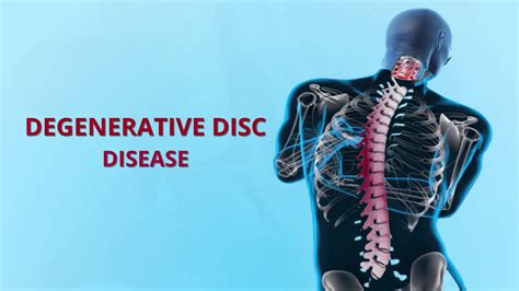 What Is Degenerative Disc Disease Ddd Symptoms And Best Treatments