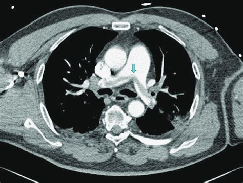 On Ct Pulmonary Angiogram Emboli Had Formed On The Bifurcation Of The Download Scientific