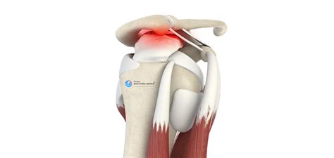 Arthroscopic Shoulder Acromioplasty Doctor Matthieu Meyer