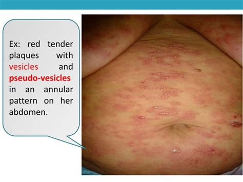 Atypical Presentations Of Erythema Nodosum Leprosum A Case Report And