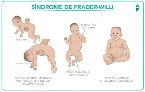 Sind De Williams - Resumo de Síndrome de Williams: causas, diagnóstico e mais!