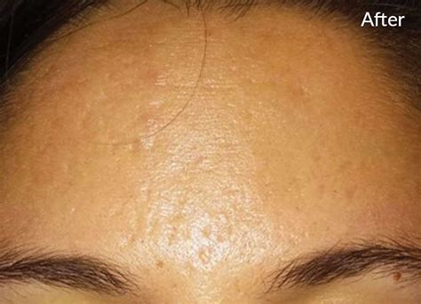 SkinPen Microneedling Fight Facial Acne Scars Crown Aesthetics