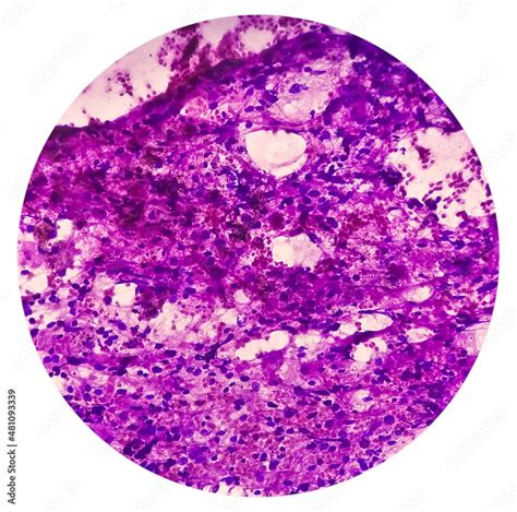 Photomicrograph Of Fine Needle Aspiration Fna Cytology Of A Pulmonary