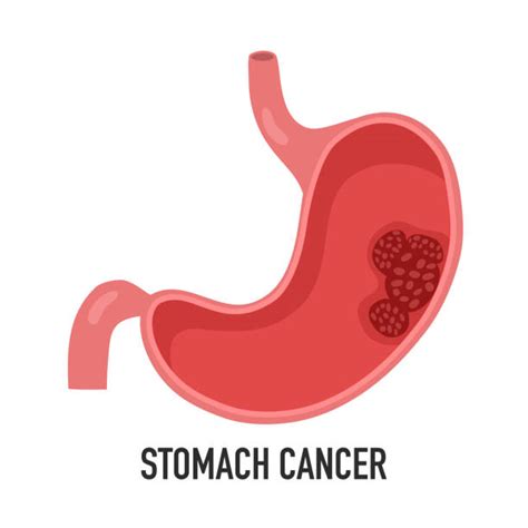 70 Stomach Cancer Cells Stock Illustrations Royalty Free Vector