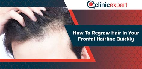 How To Regrow Hair In Your Frontal Hairline Quickly Clinicexpert