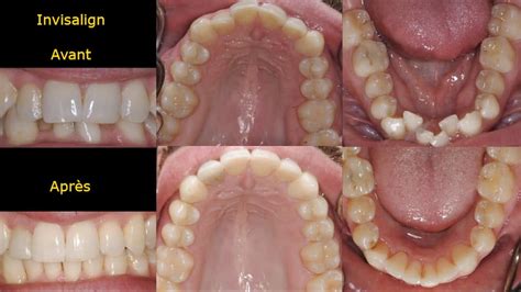 Invisalign En Turquie Tarifs Ilajak M Dical