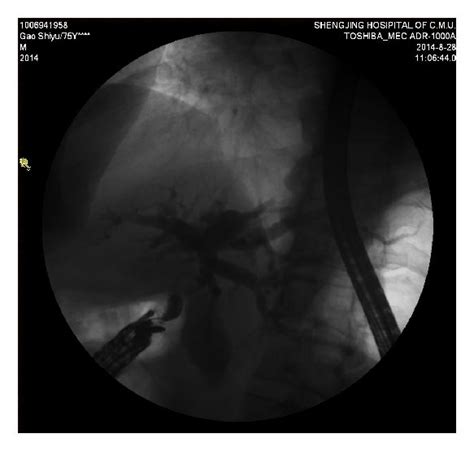 A Echoendoscope Was Advanced Into The Duodenal Bulb After Checking