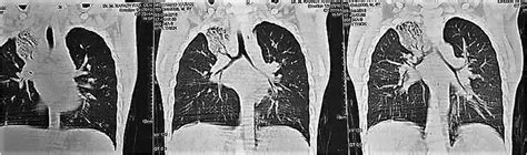 Ct Scan Chest Of The Patient Showing Right Upper Lobe Bronchiectasis Download Scientific