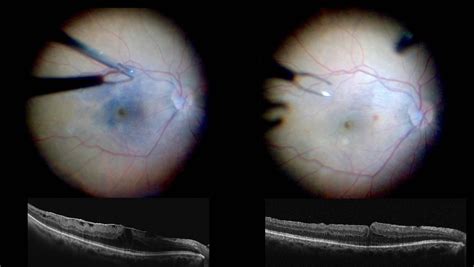 Epiretinal membrane treatment - Retina Center Tijuana