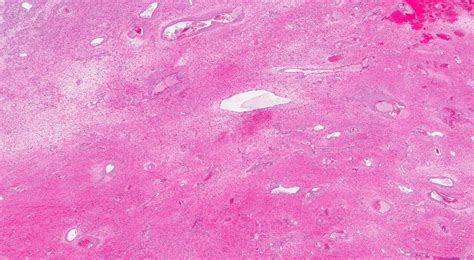 Nasopharyngeal Angiofibroma Archives Atlas Of Pathology