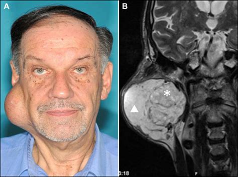 Pleomorphic Adenoma Of The Parotid Gland The American Journal Of Medicine