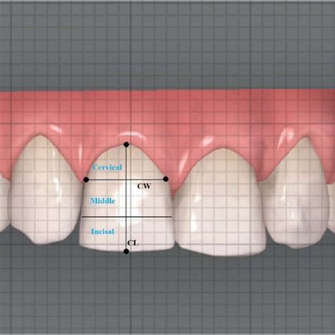 Measurement Of Central Incisor Rotation And Overlap In The Maxilla And