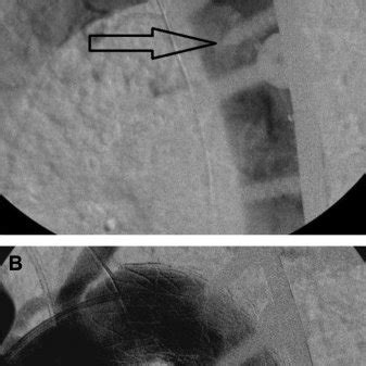 Angiography. A, Level of aortic injury identified before stent ...