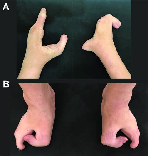 Syndactyly Webbingfusion Of Fingers And Toes A Hands And B Feet