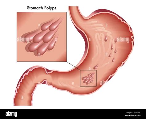 Gastric Polyp Cut Out Stock Images And Pictures Alamy