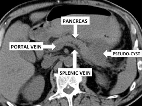 Contrast enhanced CT scan-pancreatic body pseudocyst that is in close... | Download Scientific ...