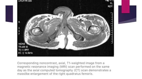 Myositis Ossificans Heterotopic Ossification