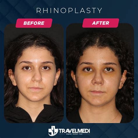 Nose Job in Turkey - Prices, Before - After 2024