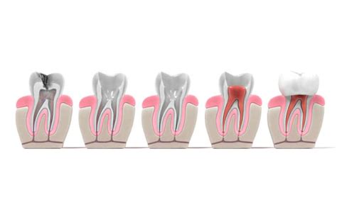 Qué es una endodoncia y en qué consiste