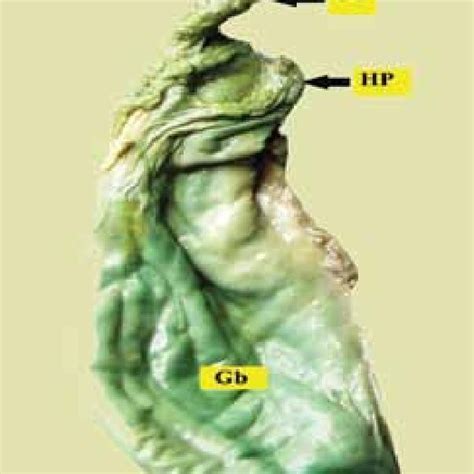 (PDF) Study of Hartmann’s Pouch of the Gallbladder