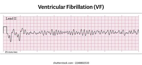 Ventricular Flutter Ecg