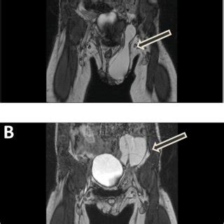 Clinical picture left scrotal swelling. | Download Scientific Diagram