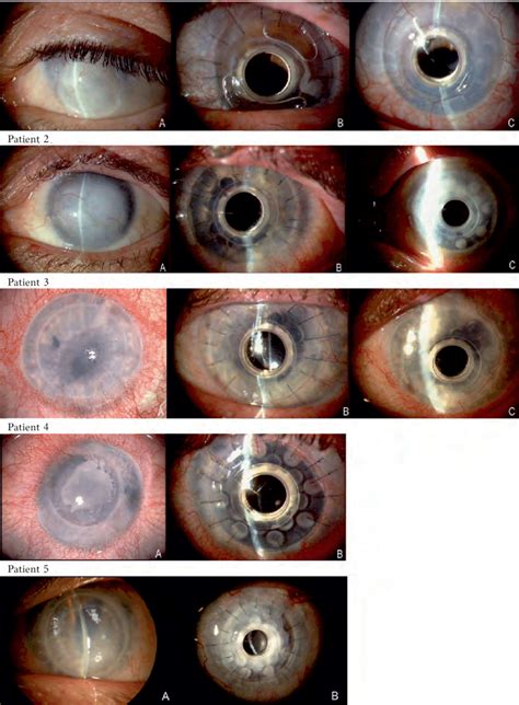 Corneal Transplant Before And After