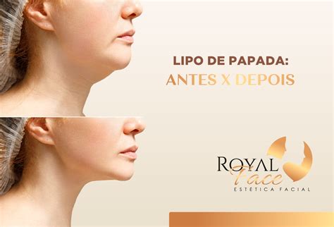 Lipo De Papada Confira O Antes E Depois Deste Tratamento Royal Face