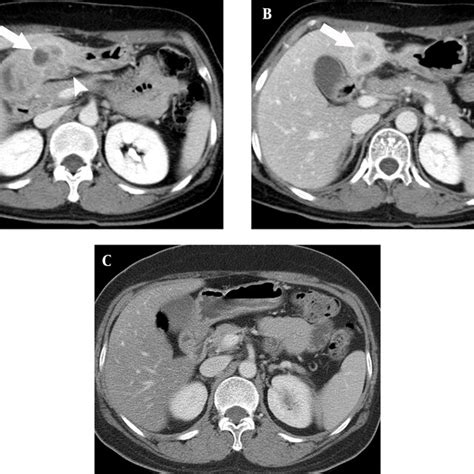 A 49 Year Old Woman With An Inflammatory Myofibroblastic Tumor In The